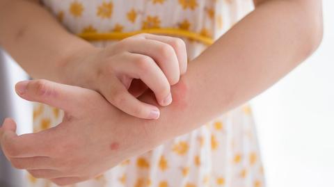 In Latvia ticks and mosquitoes are warming up for their summer season